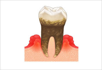 歯周病治療