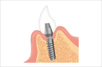 インプラント治療